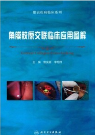 角膜胶原交联临床应用图解