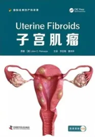 子宫肌瘤