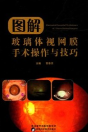 图解玻璃体视网膜手术操作与技巧