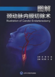 图解颈动脉内膜切除术