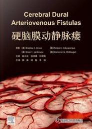 硬脑膜动静脉瘘