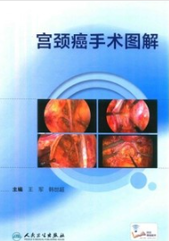 宫颈癌手术图解