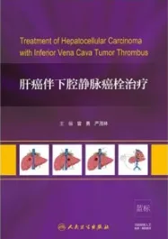 肝癌伴下腔静脉癌栓治疗
