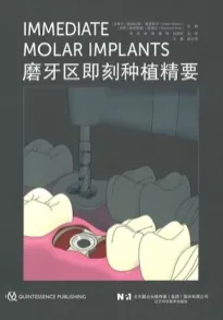 磨牙区即刻种植精要