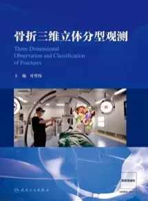 骨折三维立体分型观测