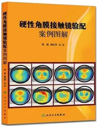 硬性角膜接触镜验配案例图解